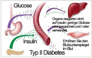 Ursachen Diabetes