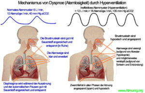Arbeitsatmung - Atemnot